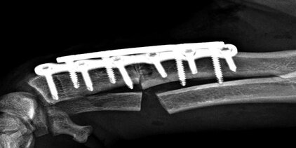 Umstellungsosteotomie Knochenoperation