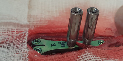 Knochenchirugie Plattenosteosynthese Titanimplantate Leilox